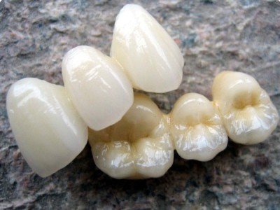 Керамические зубы из титана